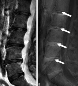 Spinal News International -- https://2gqxdz37ufsd58kadactjhkf-wpengine.netdna-ssl.com/wp-content/uploads/sites/11/2017/08/MRI-of-the-lumbar-spine-of-a-subject-with-chronic-low-back-pain-and-disability.jpg